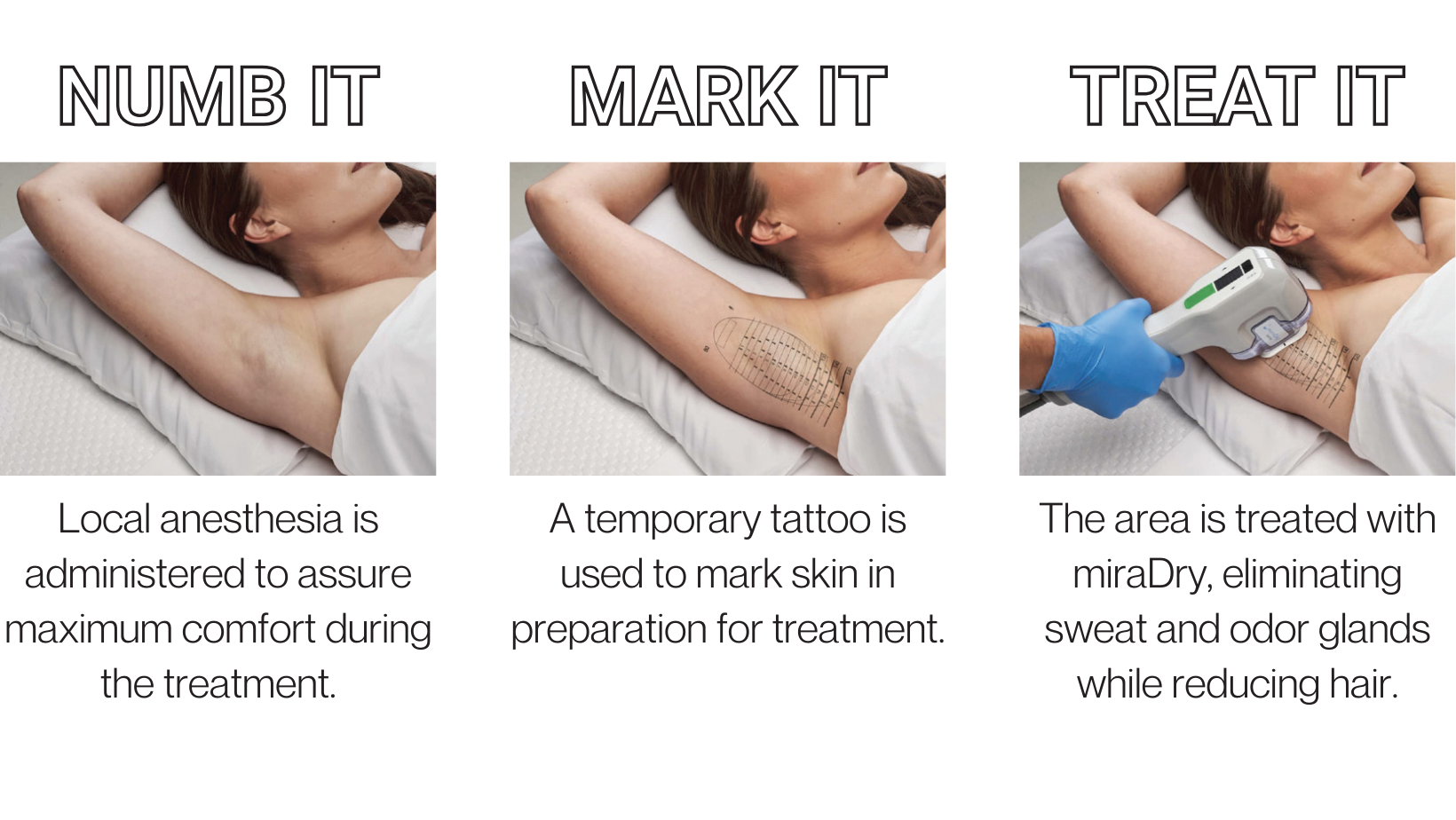Three-step miraDry treatment process shown. Step one, “Numb It,” shows a patient lying down with one arm raised as local anesthesia is administered to the underarm. Step two, “Mark It,” shows a temporary grid-like tattoo marking applied to the underarm to prepare for treatment. Step three, “Treat It,” shows a provider using the miraDry handheld device on the marked underarm area to reduce sweat and odor glands and minimize hair.